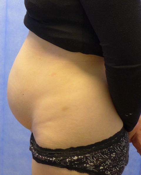 Before: Abdominoplasty lateral