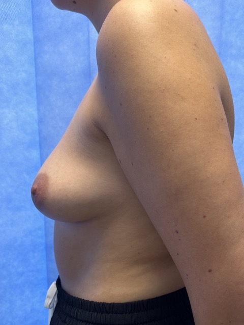 Before — Breast Augmentation 360cc Motiva lateral