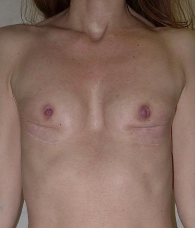 Before — Breast Augmentation with Own Tissue AP