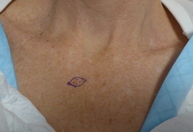 Before — BCC excision décolletage, pre-operative markings