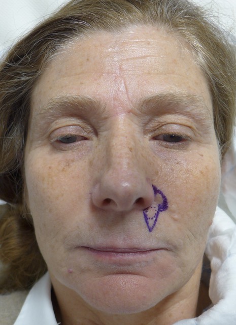 Before — BCC excision top lip with perialar advancement flap, AP view