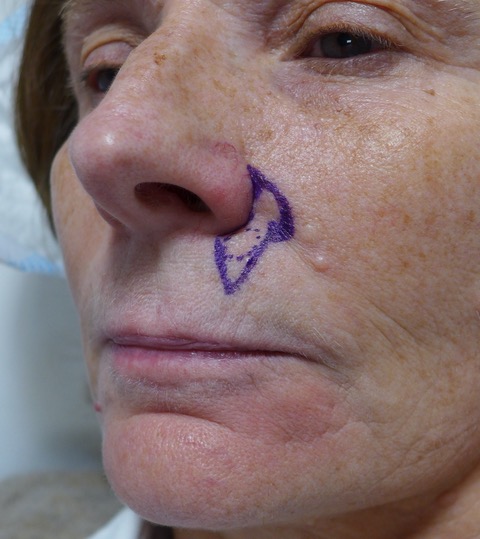Before — BCC excision top lip with perialar advancement flap, oblique view