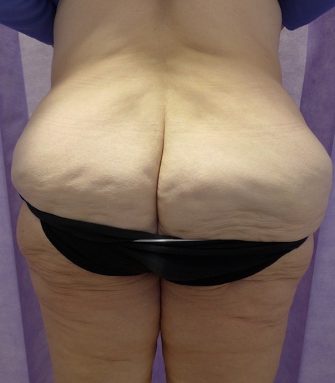 Before: 360° Belt Lipectomy posterior view