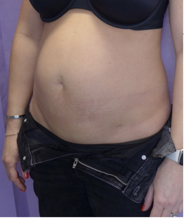 Before — Abdominoplasty with rectus plication oblique