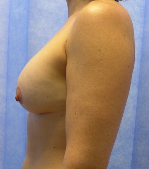 Before: Implant Exchange, Capsulectomy & Mastopexy lateral