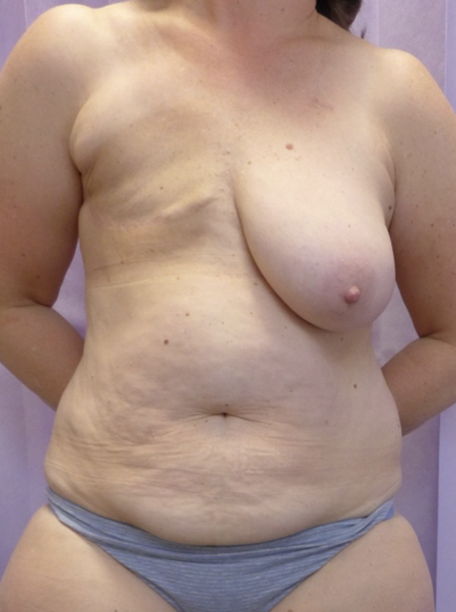 Before — Delayed DIEP Flap Breast Reconstruction AP