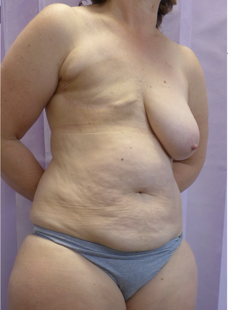Before — Delayed DIEP Flap Breast Reconstruction oblique