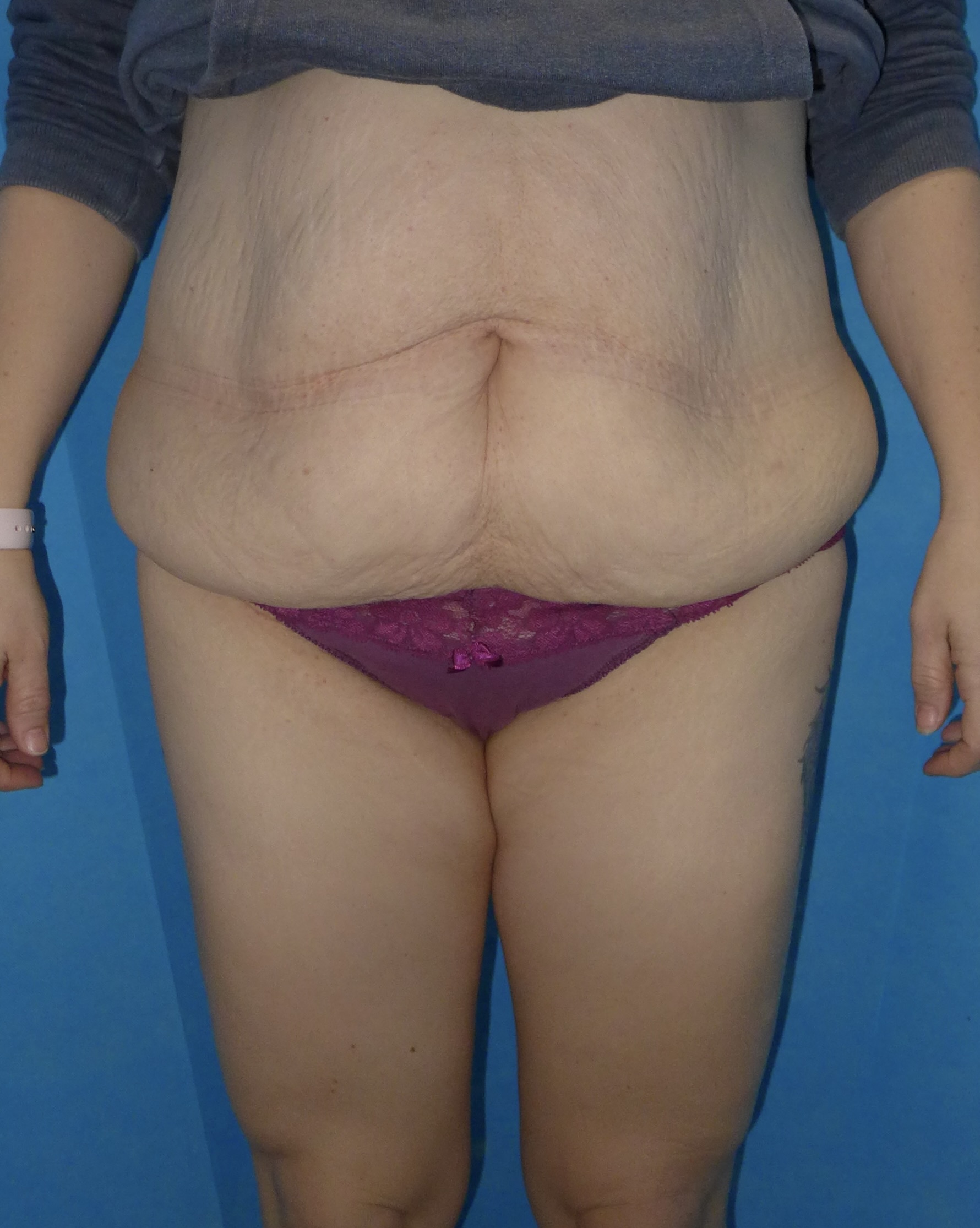 Before — Fleur-de-Lys Abdominoplasty