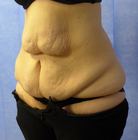 Before — Fleur-de-Lys Abdominoplasty oblique view