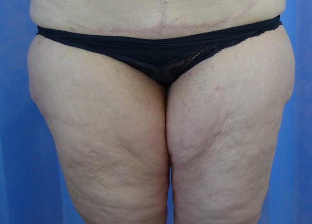 Before — Thigh Lift AP
