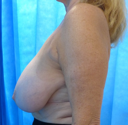 Before: Bilateral Breast Reduction lateral