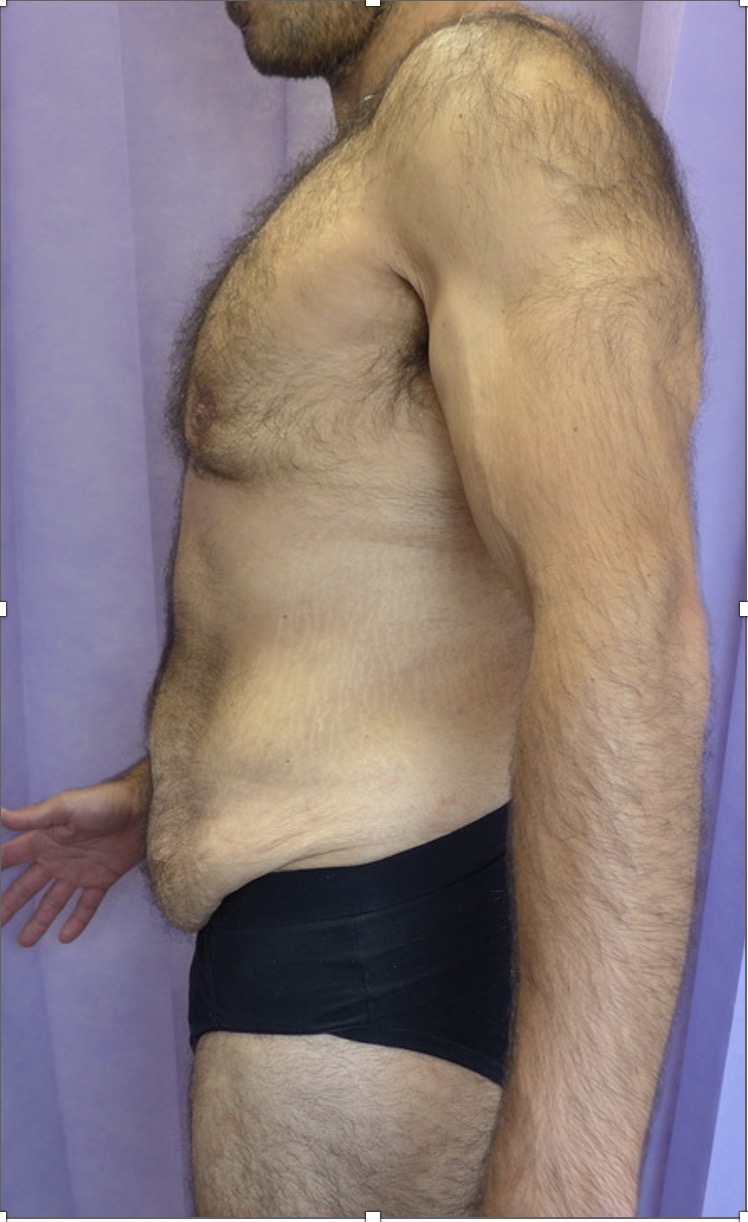 Before — Male Abdominoplasty lateral