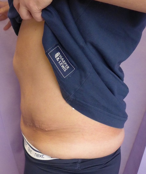 Before: Redo Abdominoplasty with Umbilical Reconstruction lateral